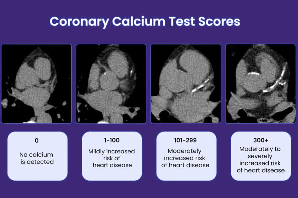 Linking Postprandial Glucose to Calcium Scoring - Peak Metabolism